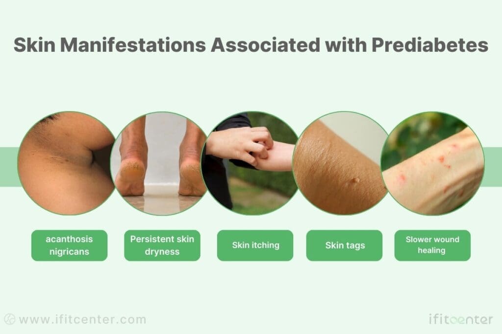 prediabetes symptoms skin tags